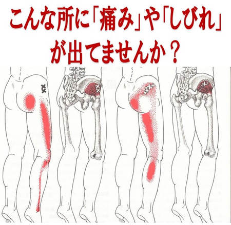 治療日記【坐骨神経痛】