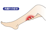 治療日記【肉離れ・アキレス腱付着部の踵の痛み】